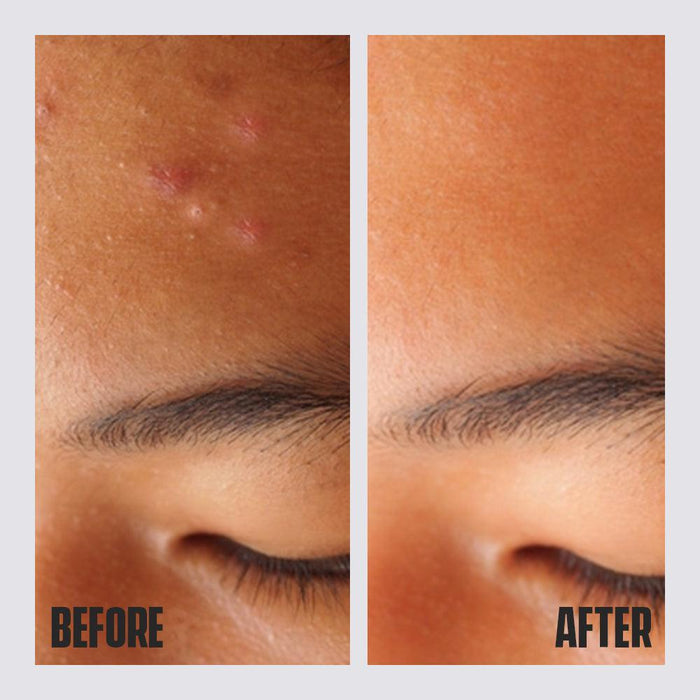 Acne Spot Gel - Dari Mooch