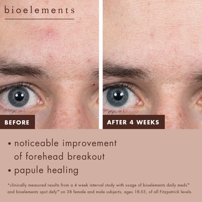 Before: Visible forehead breakouts. After four weeks: Noticeable improvement of forehead breakout. Papule healing. Clinically measured results from a 4-week interval study of daily meds and spot defy on 38 female and male subjects ages 18=55 of all Fitzpatrick levels.