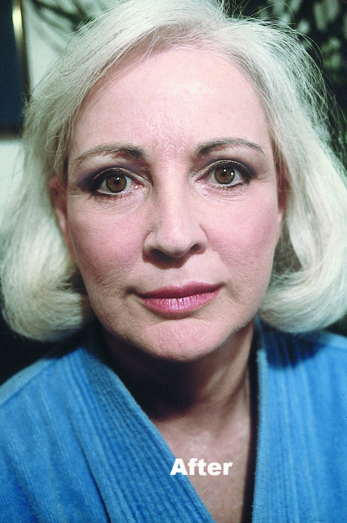 Image of woman with smooth skin after applying No Lines