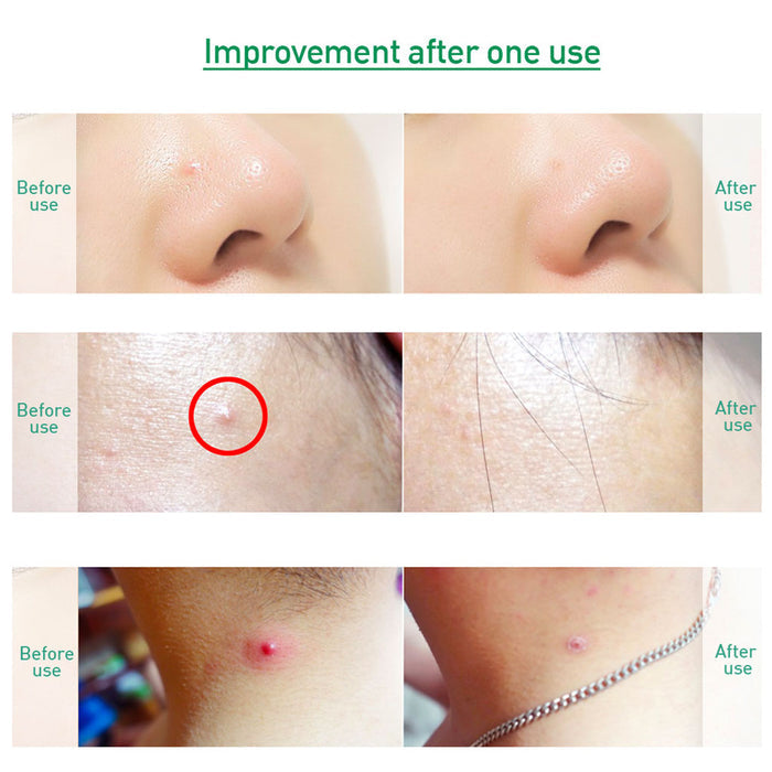 Acropass Trouble Cure Nudie Glow Australia